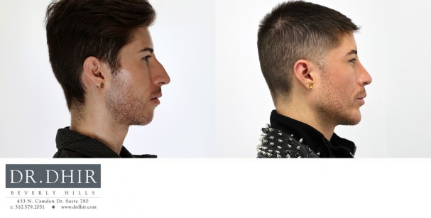 33 year old Hispanic Male underwent custom jaw/mandible implant to improve an underdeveloped chin, jaw angle with a 3d customized jaw line contour.  In addition, he underwent a rhinoplasty and buccal fat removal.