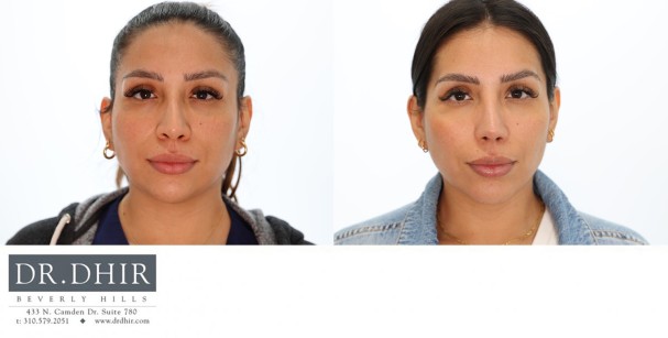 33 year old Hispanic Female underwent chin impant for an underprojected chin and improved neck line.  She also underwent rhinoplasty and buccal fat removal.