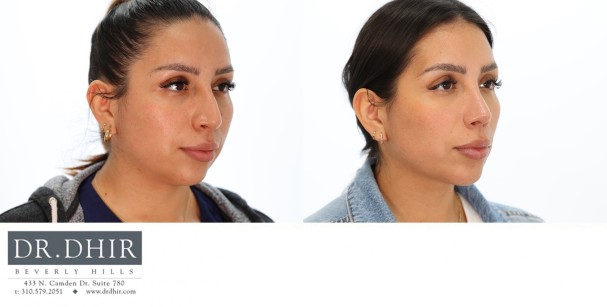 33 year old Hispanic Female underwent chin impant for an underprojected chin and improved neck line.  She also underwent rhinoplasty and buccal fat removal.