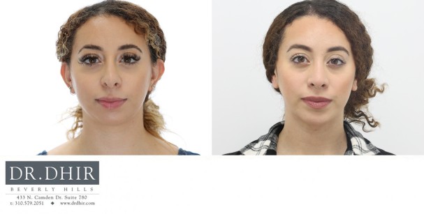 30 yr old Hispanic female presented for revision rhinoplasty and chin implant augmentation.  A chin implant was performed for improved chin projection and facial harmony.  This improved the neck contour and balanced the nasal tip.  A revision rhinoplasty was performed to deproject  and refine the nasal tip.