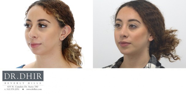 30 yr old Hispanic female presented for revision rhinoplasty and chin implant augmentation.  A chin implant was performed for improved chin projection and facial harmony.  This improved the neck contour and balanced the nasal tip.  A revision rhinoplasty was performed to deproject  and refine the nasal tip.