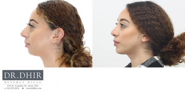 30 yr old Hispanic female presented for revision rhinoplasty and chin implant augmentation.  A chin implant was performed for improved chin projection and facial harmony.  This improved the neck contour and balanced the nasal tip.  A revision rhinoplasty was performed to deproject  and refine the nasal tip.