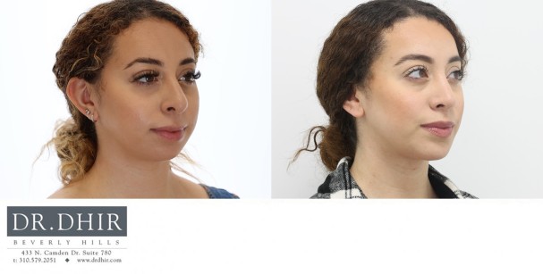 30 yr old Hispanic female presented for revision rhinoplasty and chin implant augmentation.  A chin implant was performed for improved chin projection and facial harmony.  This improved the neck contour and balanced the nasal tip.  A revision rhinoplasty was performed to deproject  and refine the nasal tip.