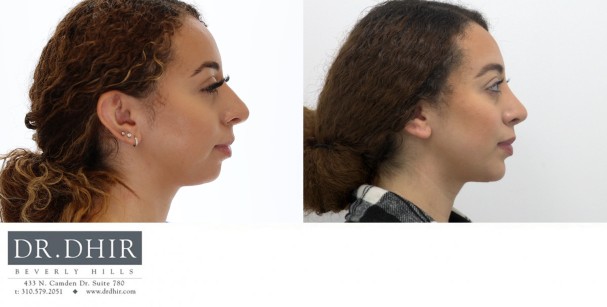 30 yr old Hispanic female presented for revision rhinoplasty and chin implant augmentation.  A chin implant was performed for improved chin projection and facial harmony.  This improved the neck contour and balanced the nasal tip.  A revision rhinoplasty was performed to deproject  and refine the nasal tip.