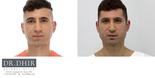 30 Year old male with an underdeveloped jawline underwent a 3D custom designed jaw implant.