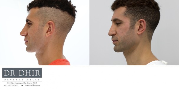 30 Year old male with an underdeveloped jawline underwent a 3D custom designed jaw implant.