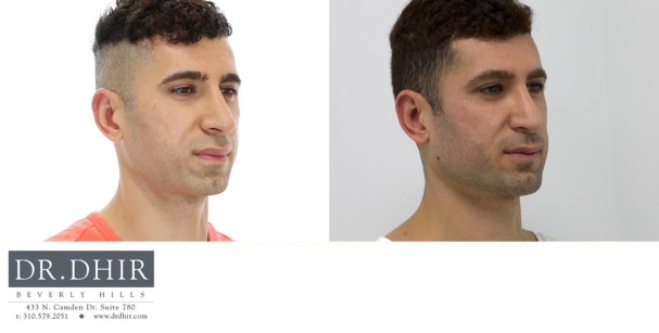 30 Year old male with an underdeveloped jawline underwent a 3D custom designed jaw implant.
