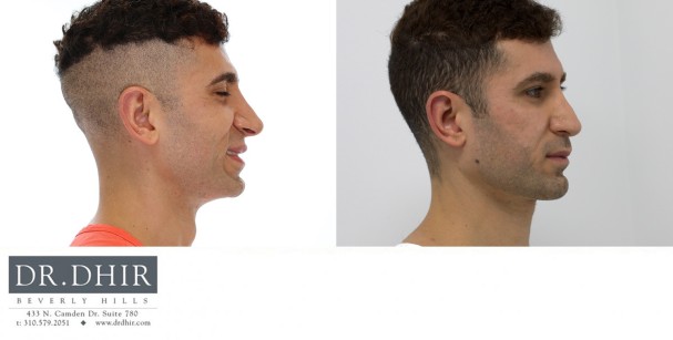 30 Year old male with an underdeveloped jawline underwent a 3D custom designed jaw implant.