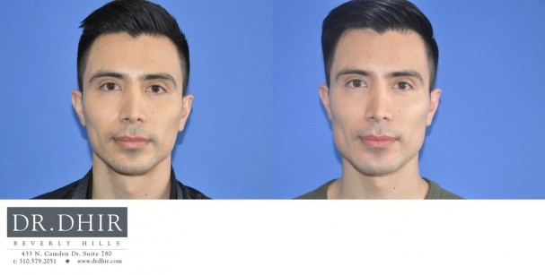 40 year old Male presented for revision custom mandibular implant.  The patient wanted a customized chin shape and jaw contour.  A CT scan was performed and a 3D medical software was utilized to create a custom implant.