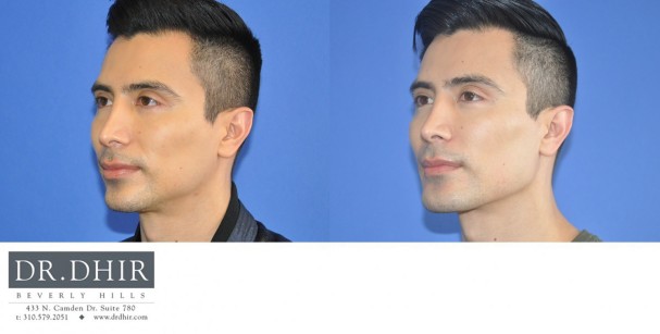 40 year old Male presented for revision custom mandibular implant.  The patient wanted a customized chin shape and jaw contour.  A CT scan was performed and a 3D medical software was utilized to create a custom implant.
