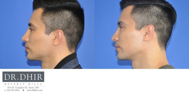 40 year old Male presented for revision custom mandibular implant.  The patient wanted a customized chin shape and jaw contour.  A CT scan was performed and a 3D medical software was utilized to create a custom implant.