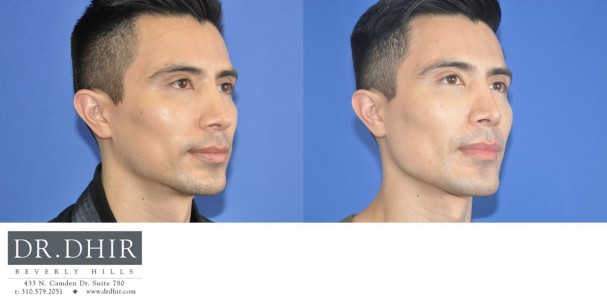 40 year old Male presented for revision custom mandibular implant.  The patient wanted a customized chin shape and jaw contour.  A CT scan was performed and a 3D medical software was utilized to create a custom implant.