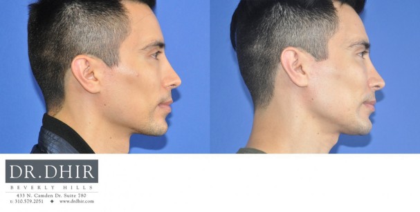 40 year old Male presented for revision custom mandibular implant.  The patient wanted a customized chin shape and jaw contour.  A CT scan was performed and a 3D medical software was utilized to create a custom implant.