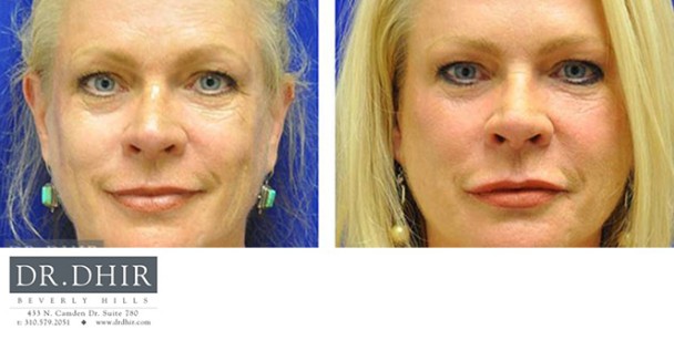 Botox-1