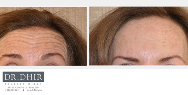 Botox-2