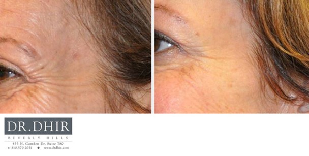 Botox-3