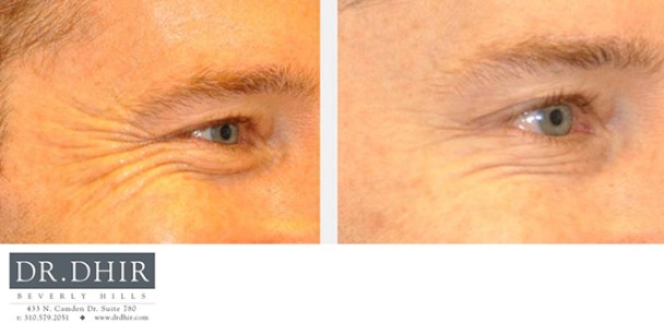Botox-4