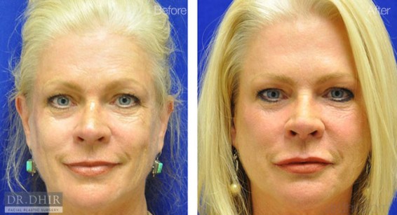 botox4