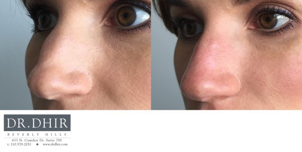 drdhir-Fillers-3