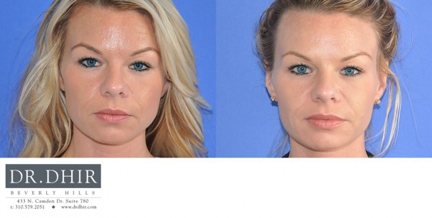 drdhir-botox-6-1