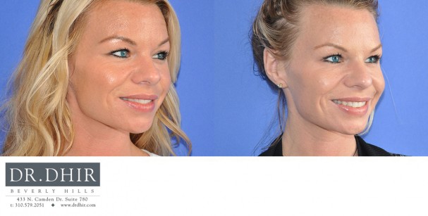 drdhir-botox-6-2