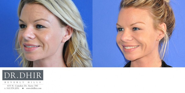 drdhir-botox-6-3