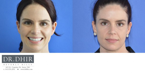 drdhir-botox-7-1
