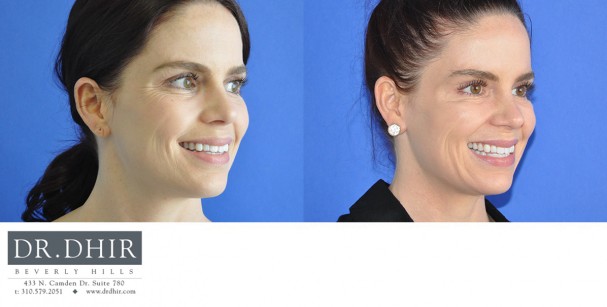 drdhir-botox-7-2