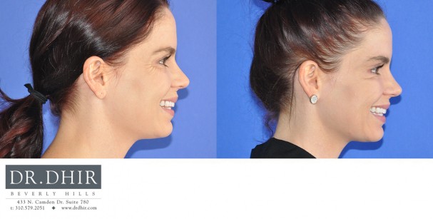 drdhir-botox-7-3