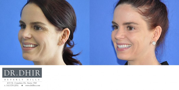 drdhir-botox-7-4
