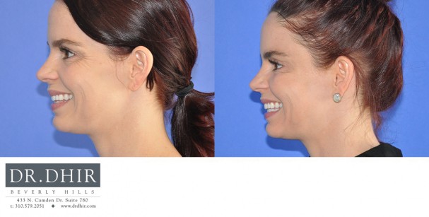 drdhir-botox-7-5