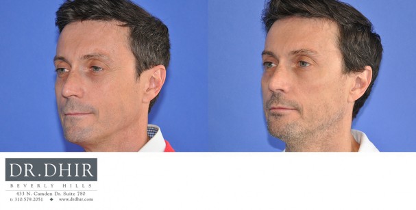 drdhir-botox-8-1
