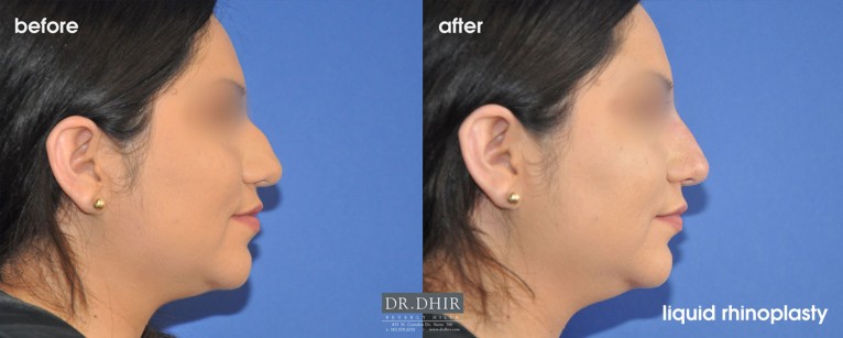 drdhir-liquid-rhinoplasty-1-2
