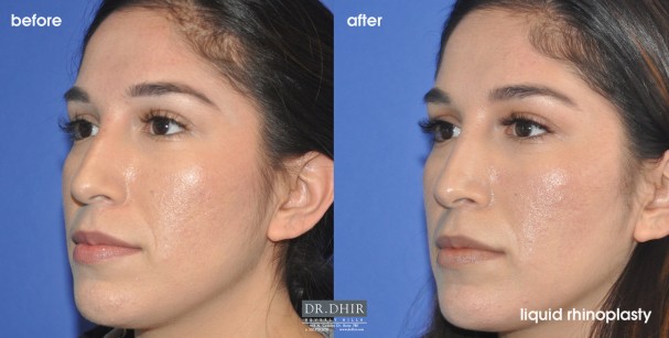 drdhir-liquid-rhinoplasty-2-1