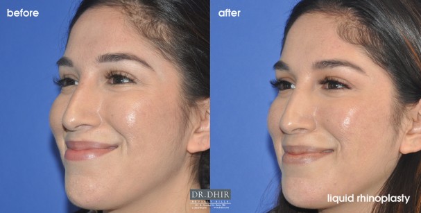 drdhir-liquid-rhinoplasty-2-2