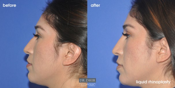 drdhir-liquid-rhinoplasty-2-3
