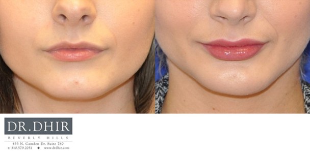 Lips-1