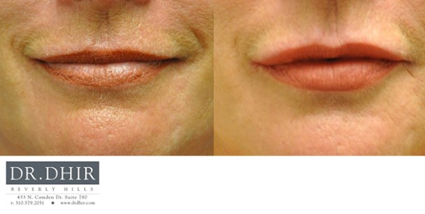 Lips-3