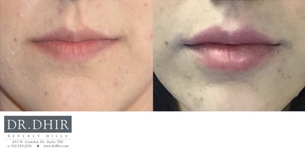 Lips-4