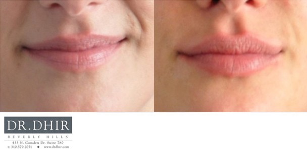 Lips-5