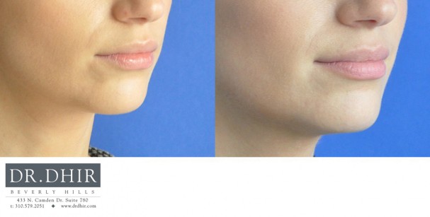 drdhir-lips-12-1