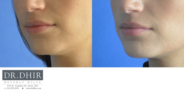 drdhir-lips-12-2