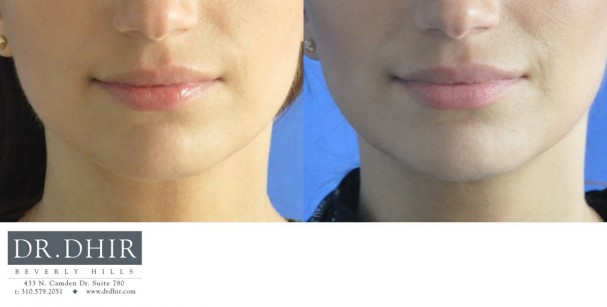 drdhir-lips-12-3