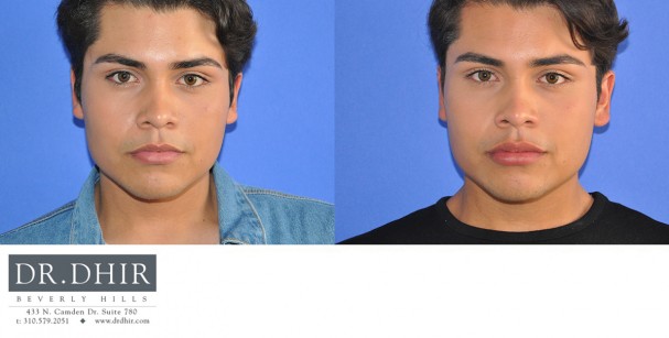 drdhir-lips-13-1