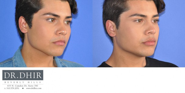 drdhir-lips-13-3