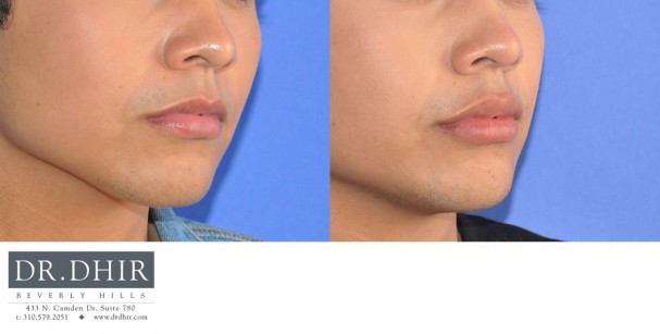 drdhir-lips-13-4