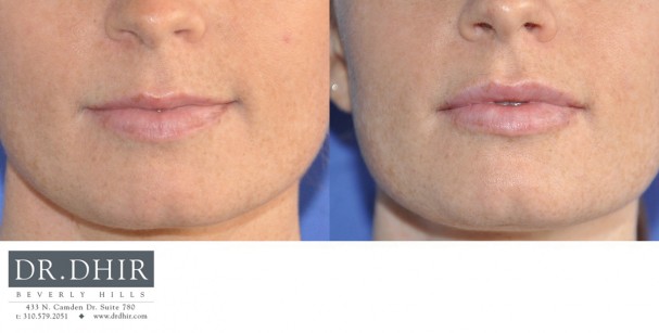 drdhir-lips-14-1