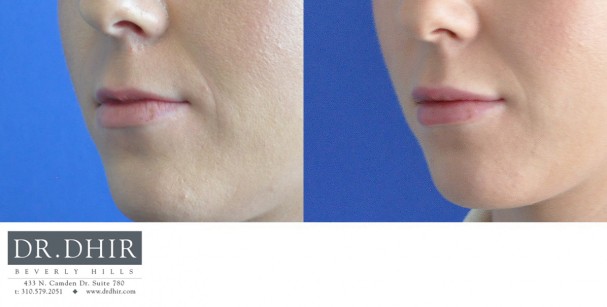 drdhir-lips-15-1