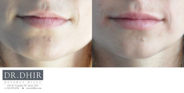 drdhir-lips-17-4