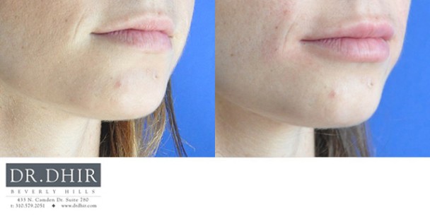 drdhir-lips-17-5